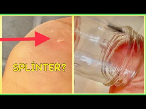 No Secret: How to Remove a Splinter Stuck from Skin (Finger, Hand, Toe ..) - 5 Easiest way - YouTube