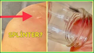No Secret: How to Remove a Splinter Stuck from Skin (Finger, Hand, Toe ..) - 5 Easiest way