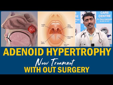 What are Adenoid hypertrophy ? | Infected adenoids in children: Signs, Symptoms | Dr Anjaneyulu CH