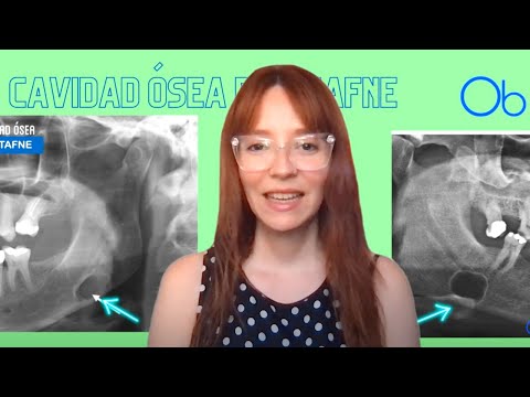 Cavidad ósea de Stafne