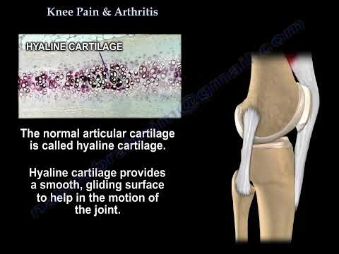 Artritis de rodilla: manejo del dolor y tratamiento del cartílago