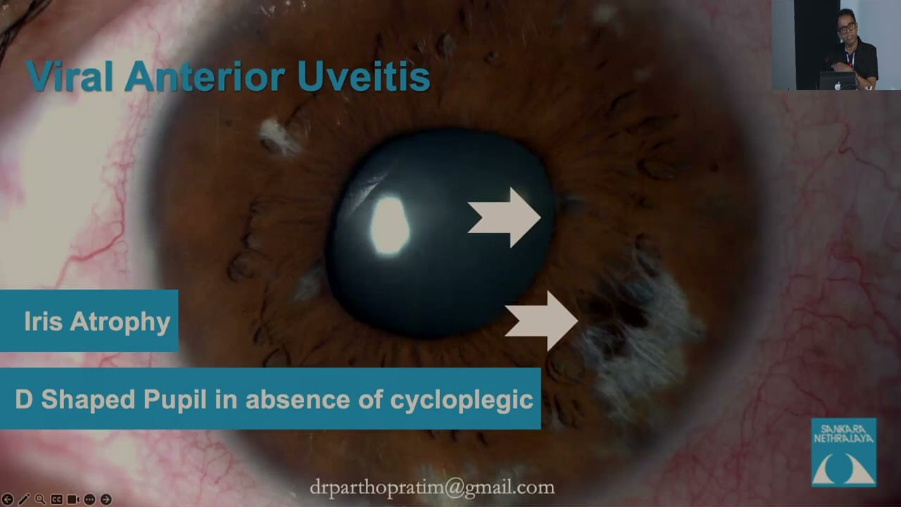 Evaluation of a Patient with Uveitis