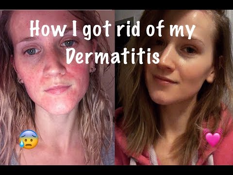 dermatitis kezelése férgekkel