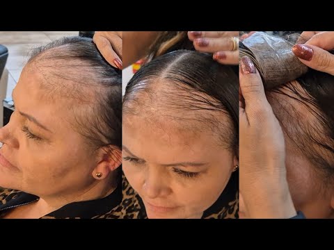 Is there a solution for female baldness? | Adhesive mega hair + hair prosthesis!