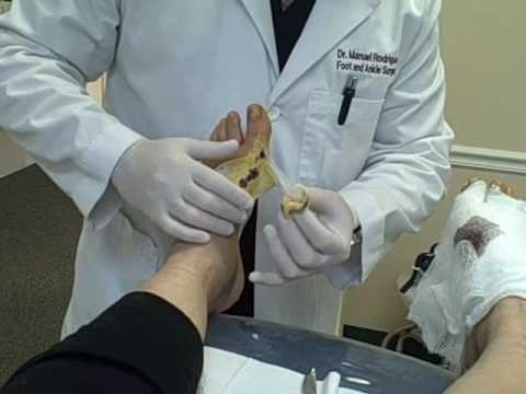 Removing staples from bunionectomy incisions