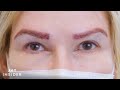 Eyebrow Transplant Before And After