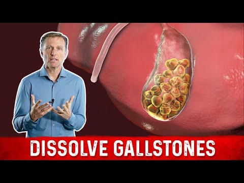 What Causes Gallstones & How to Treat Them – Dr.Berg