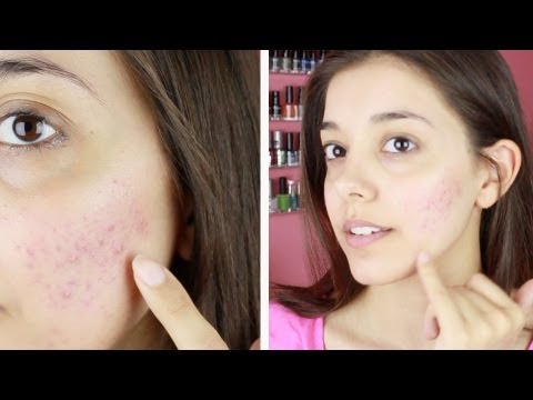 Ragione batteri di acne