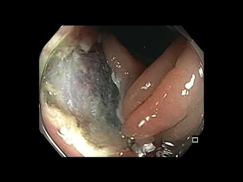 Colonoscopy: Descending Colon Suction EMR of Tethered Polyp