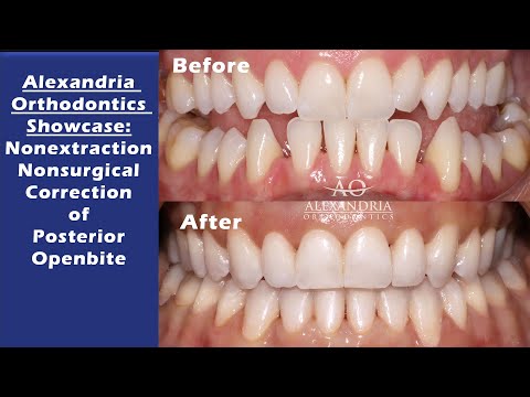 Alexandria Orthodontics Showcase: Nonsurgical Correction of Posterior Openbite
