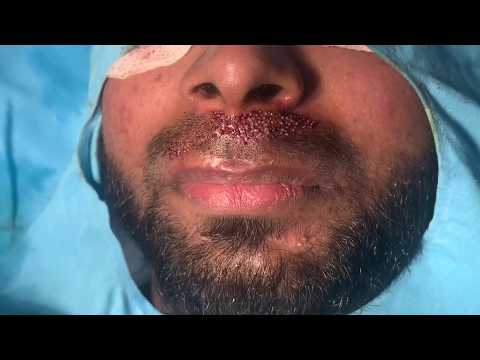 Dense Beard And Moustache By Hair Transplantation