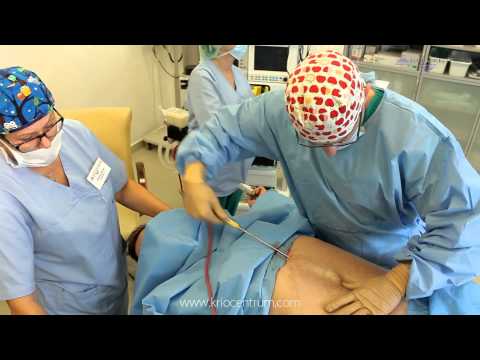 Kriocentrum - Liposukcja brzucha metodą VaserLipo HD