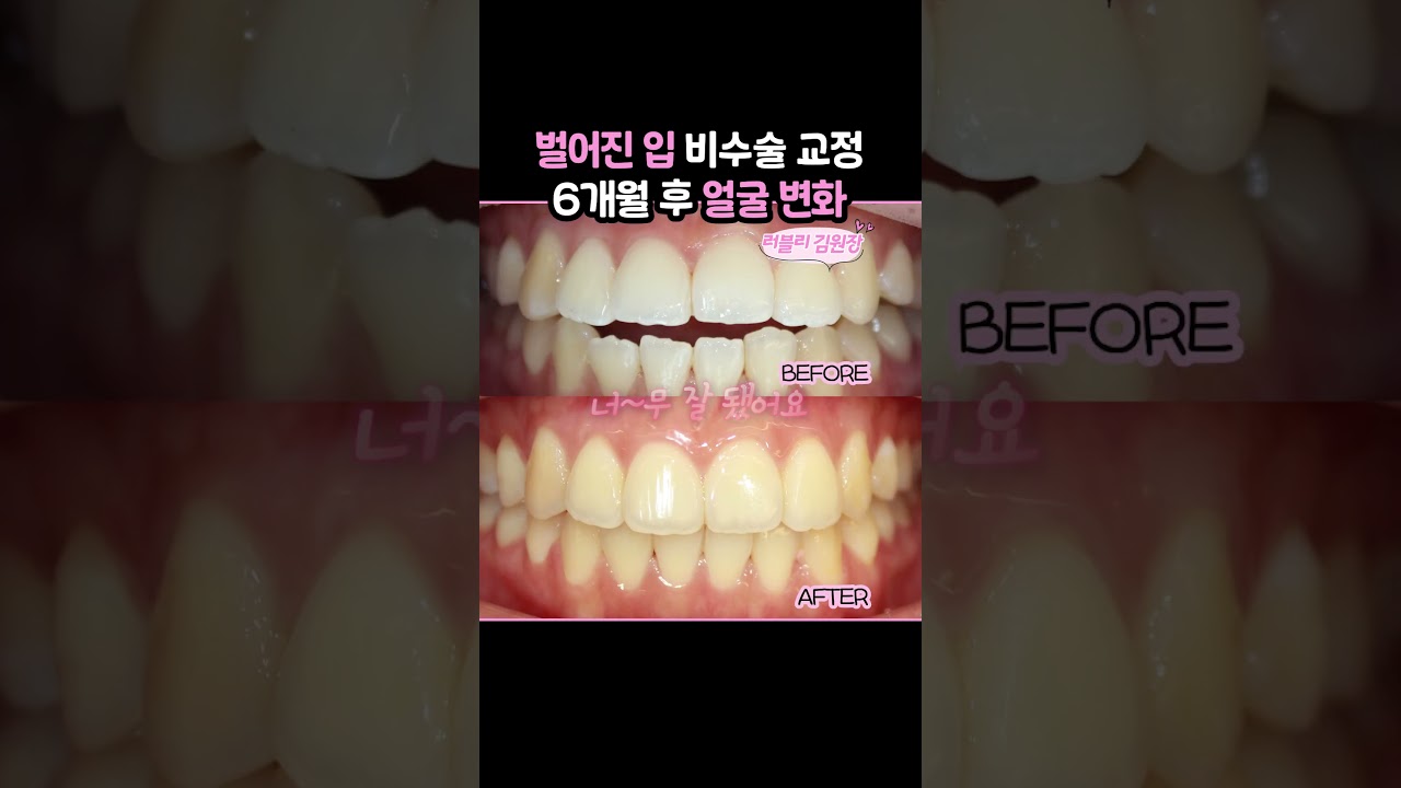 暴牙非手術矯正6個月後的面部變化