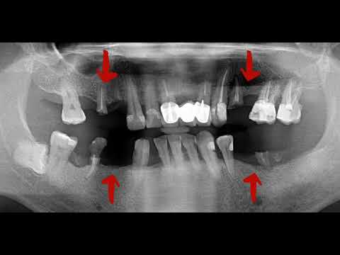 🏆植牙分享5 -- I8Q4  光遠牙醫柯秀伶專科醫師