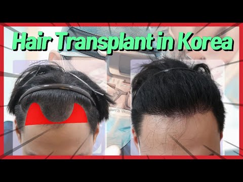 FUSS hair transplant in korea (4,300 hairs) ROOT Hair Transplantation center in SEOUL