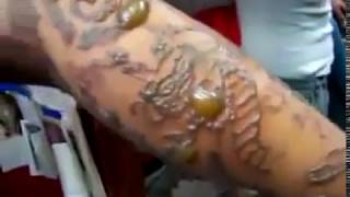 Infected Tattoo After Using Dirty Needle