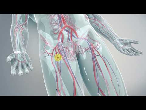 TAVR Patient Procedural Animation Final
