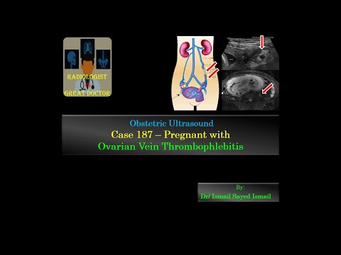Ultrasound Case 187 - Pregnant with Ovarian Vein Thrombophlebitis