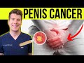 Doctor Explains PENIS CANCER Symptoms Causes And Treatment