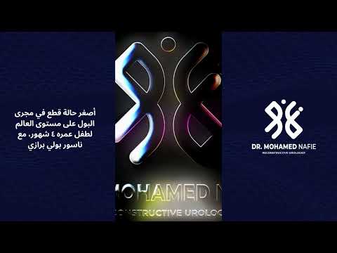 أصغر حالة قطع في مجرى البول على مستوى العالم لطفل عمره ٤ شهور، مع ناسور بولي برازي