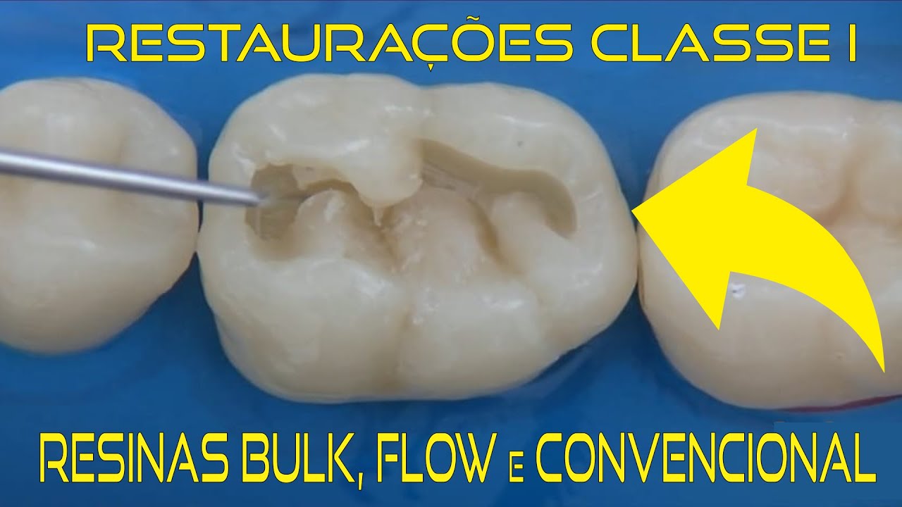 03 Técnicas para Restauração Classe I em Resina Composta