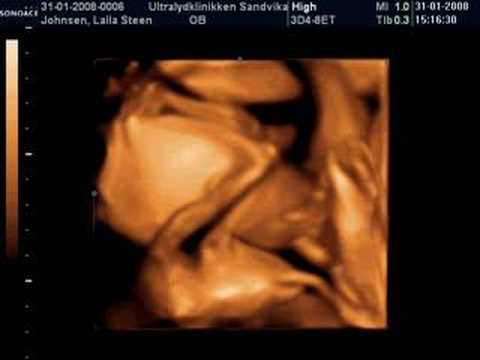 3D ultralyd / ultrasound