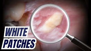 White Patches - When to Refer + Diagnoses ORAL MED - PDP206