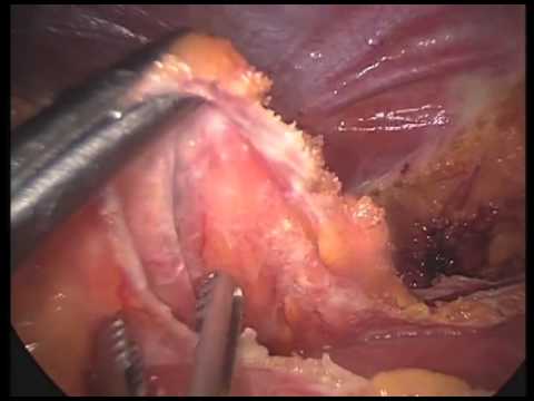 Laparoscopic Repair Of Left Posterior Diaphragmatic Hernia (Bochdaleck) With Mesh