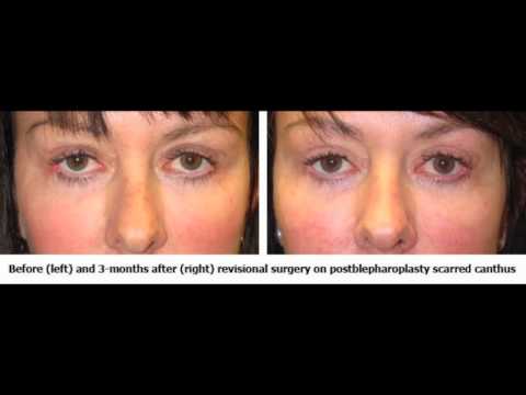 TabanMD Oculoplastic Surgeon: What is Canthoplasty? TabanMD Oculoplastic Surgeon: What is Canthoplasty?