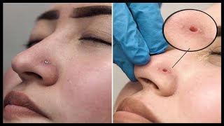 Emergency Nose Piercing Removal *BIG HOLE*