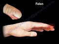 Infection of the finger. what is a felon finger. Diagnosis and treatment of a felon.