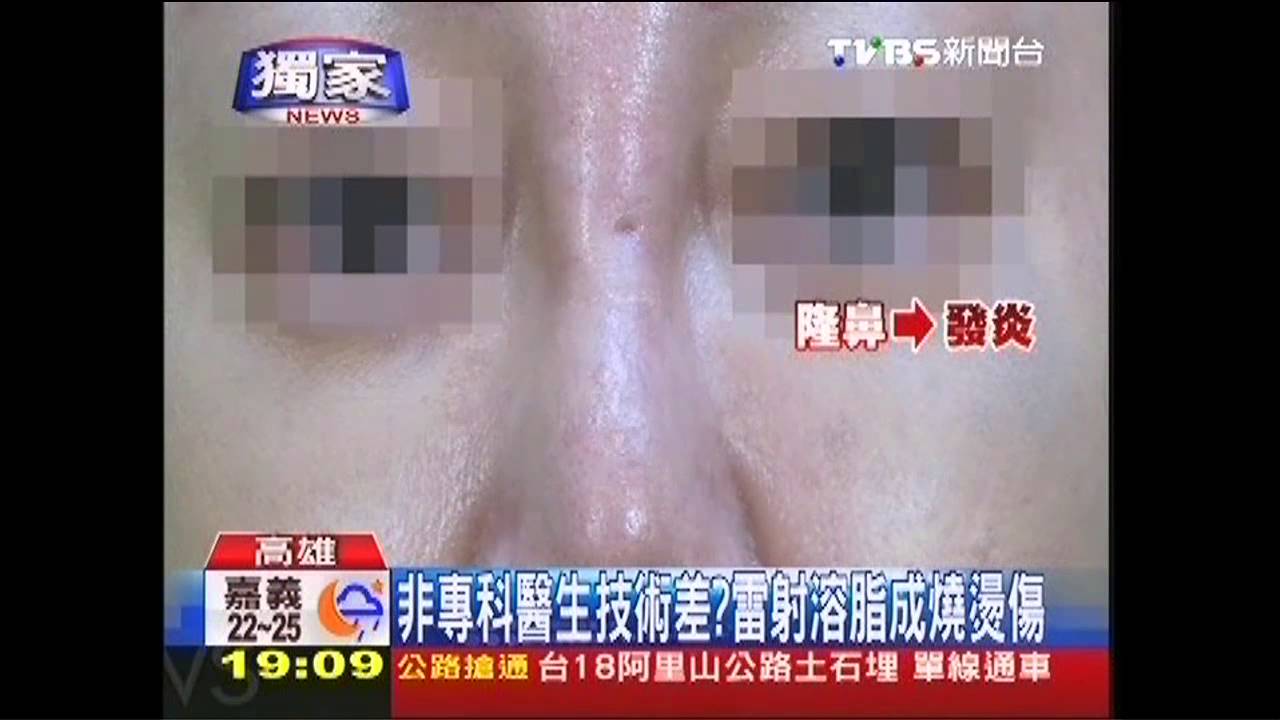 〈獨家〉醫美浮濫！愛美整形　民眾燙傷、毀容頻傳