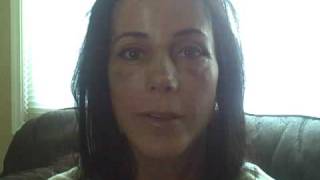 My Facial Plastic Surgery Blog – Recovery Day 13
