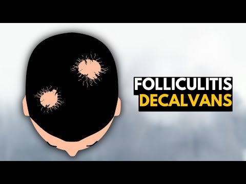 Valley Fever Causes Signs and Symptoms Diagnosis and Treatment