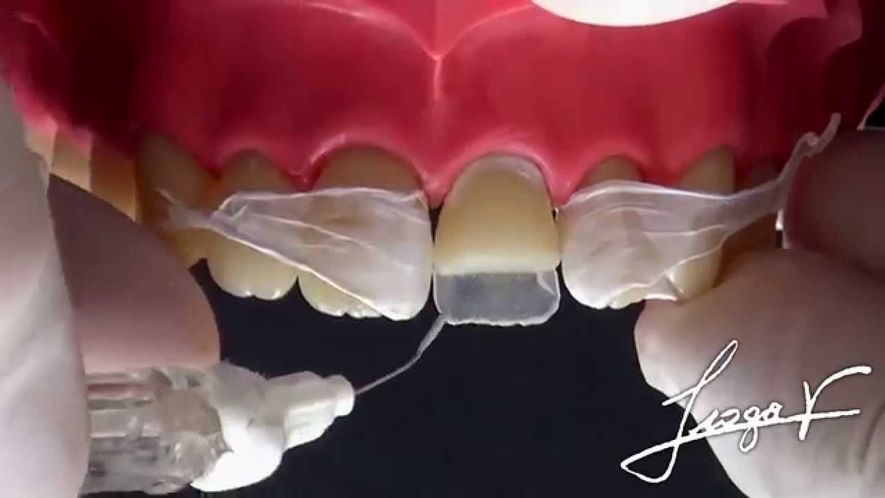 faceta em resina: Passo a passo da técnica direta