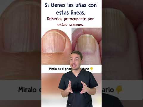 Tienes estas líneas en tus uñas?