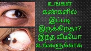 Common eye problems in Tamil || Brown spot on eye || conjunctival nevus || 3RosesLifeStyle