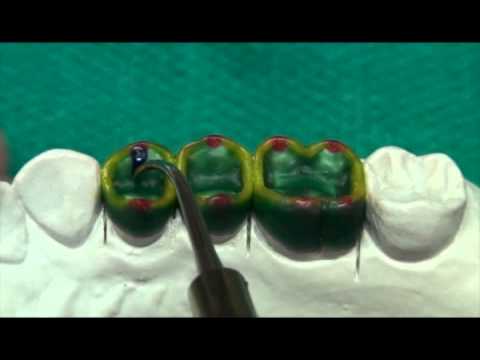 Deciphering Occlusion and Occlusal Morphology Through the Wax Additive Method