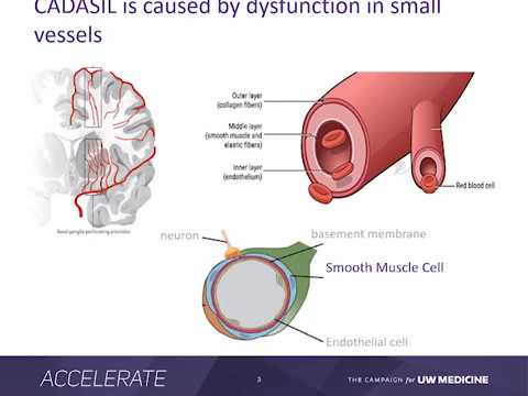 CADASIL seminar at University of Washington Medical Center - YouTube