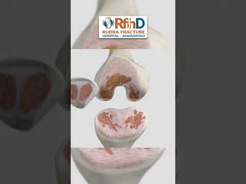 कैसे होती है Knee Replacement Surgery?