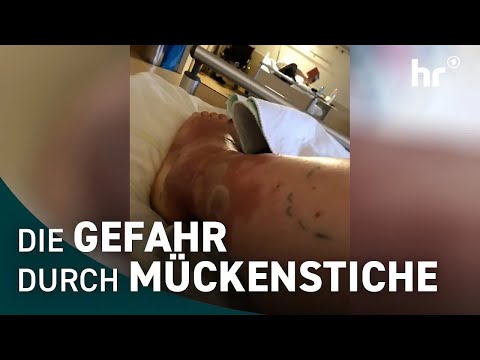 Warum man Mückenstiche nicht unterschätzen sollte