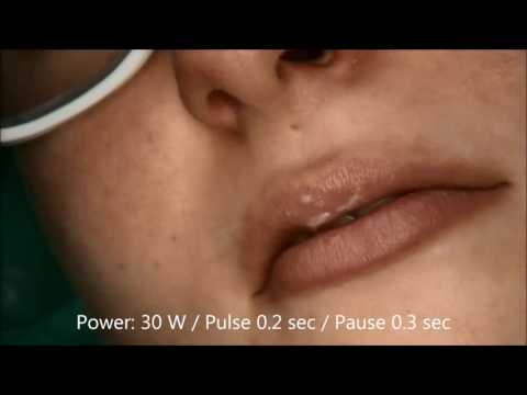 Limax® 1064 – Dermatology vascular surgery (4 cases)