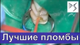 Как за рубежом ставят высококачественные пломбы Терапевтическая и ортопедическая стоматология