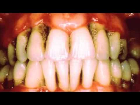 Insidermedicine in 60 - May 26, 2009