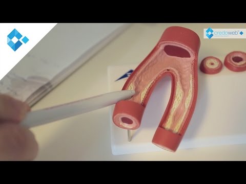Volksheilmittel, die den Blutdruck senken Hypertension Schritt 3 3 3 Grad Risiko einer Behinderung