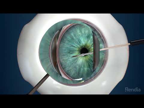 iStent inject Animation