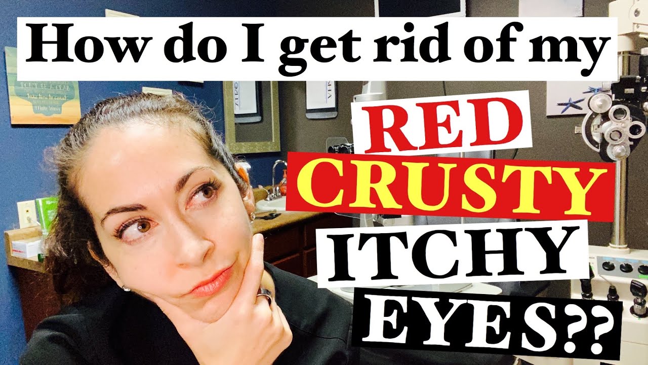 Blepharitis | 2 Easy steps to banish red, crusty, itchy eyes | The Eye Surgeon - YouTube