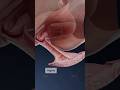 What Is Herpetic Vaginitis And How Does It Affect The Vagina Explore Gynecology In 3D With VOKA