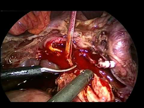 Totally Laparoscopic Whipple Procedure