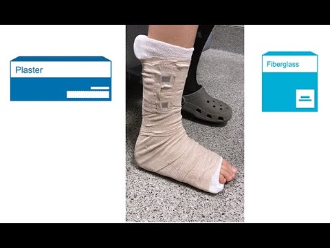 Splinting with fiberglass versus plaster